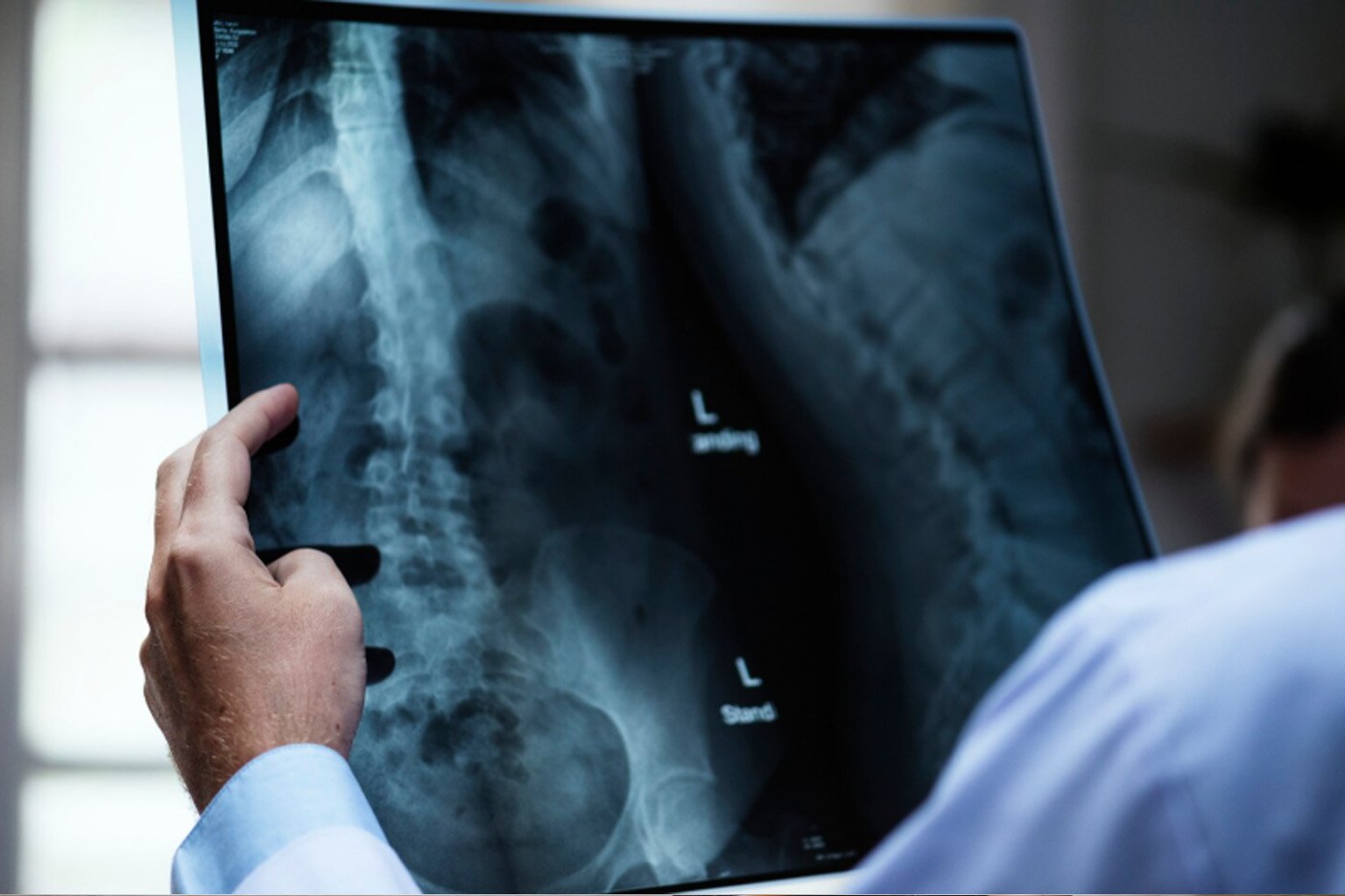 Perthes Hastalığı